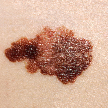 Close up of skin cancer