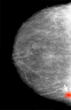 Mammogram of colloid breast cancer