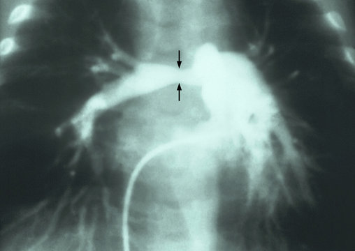 Angiocardiogram of stenosis of right pulmonary artery