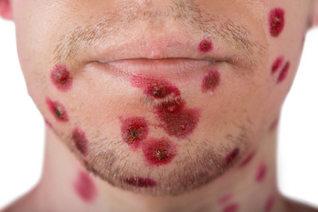 chickenpox on the face