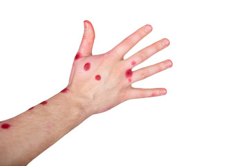 hand in chickenpox