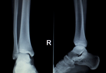 Xray foot heel ankle scan