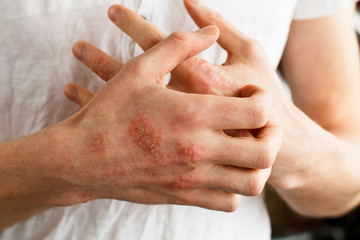 The problem with many people - eczema on hand. White background. Man itchind skin. - obrazy, fototapety, plakaty