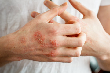 The problem with many people - eczema on hand. White background. Man itchind skin. - obrazy, fototapety, plakaty