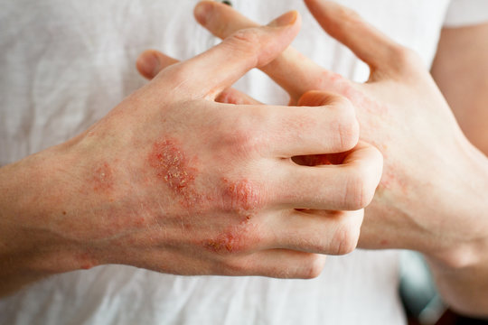 The problem with many people - eczema on hand. White background. Man itchind skin.