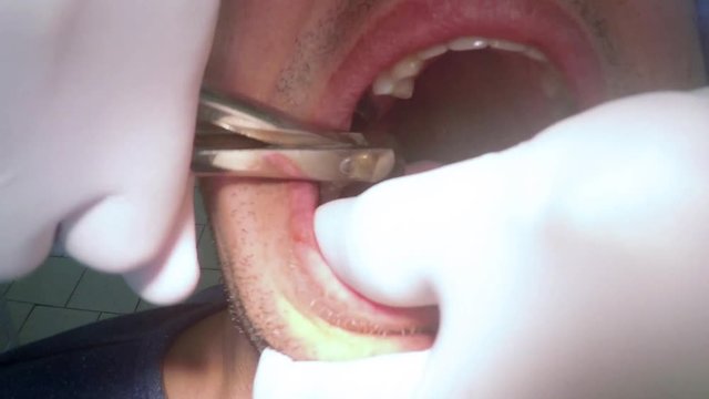 Dentist tooth extraction removal closeup