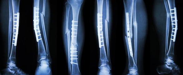 Collection image of leg fracture and surgical treatment by internal fixation with plate and screw . Break tibia and fibula bone . - obrazy, fototapety, plakaty
