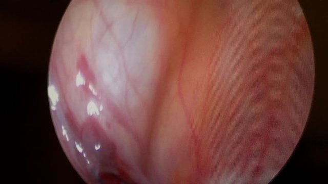 Process of endoscopic surgery on a monitor screen