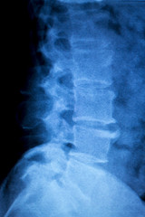 Spine hips Xray test scan
