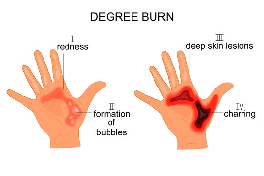 first degree burn hand