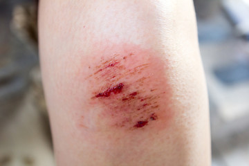 Bruised wound injury on woman knee background