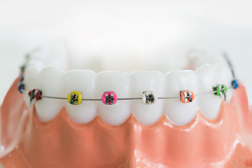 Artificial teeth model with braces