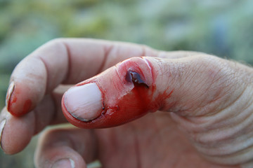 bleeding thumb