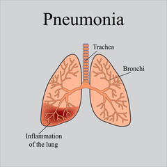 Pneumonia. The anatomical structure of the human lung. Vector illustration on a gray background