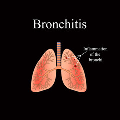 Bronchitis. The anatomical structure of the human lung. Vector illustration on a black background