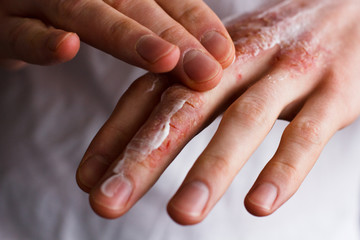 Cropped image of a young man putting moisturizer onto his hand with very dry skin and deep cracks with cream emmolient.