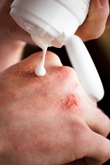 Fototapeta premium Dermatologist doctor doing treatment, male patient with allergic rash dermatitis eczema skin, Skin diseases.