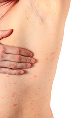 allergische reaktion