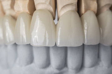 Ceramic teeth in the front