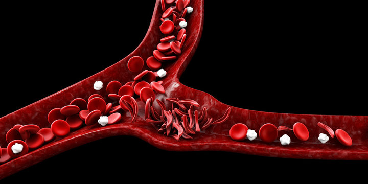 sickle cell vs normal cell