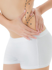 Woman grabbing skin on her flanks with the black color crosses marking, Lose weight and liposuction...
