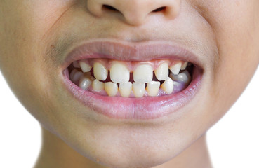 Fototapeta premium Front teeth gaps / Diastemas