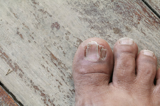 ingrown nail Big toe selective focus, broken toenail on wooden floor background