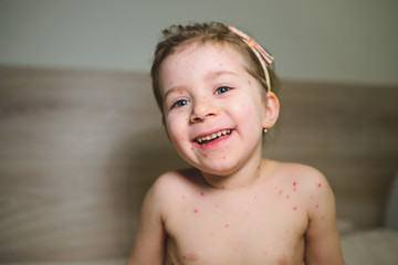Girl with Chickenpox Illness