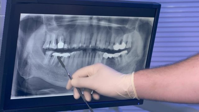 X-ray panoramic picture of the teeth and a dentist's hand with the tool moves across the screen