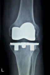 Orthopedic knee implant Xray scan