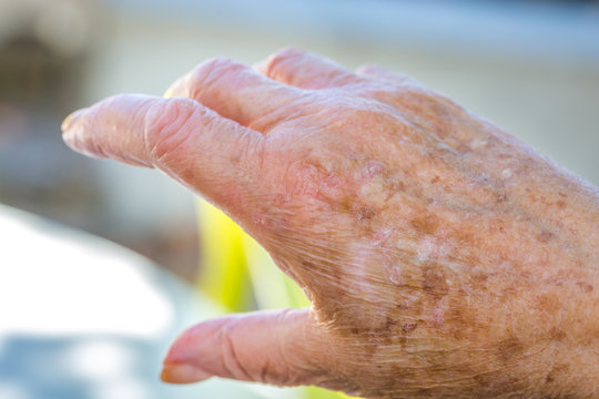 hands of old woman with skin problems