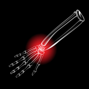 Arm bone and finger bone,pain,x ray