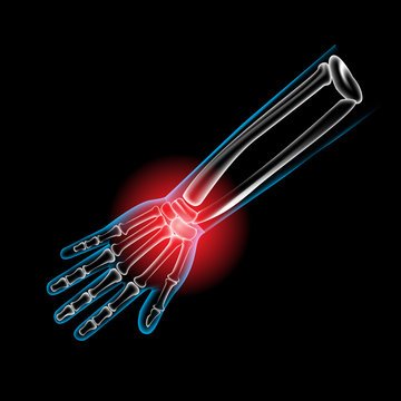 Arm bone and finger bone,pain,x ray