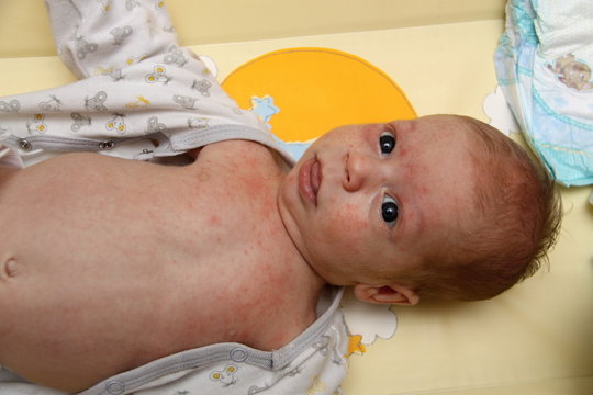 Erythema Infectiosum Infected Child On Yellow Pad