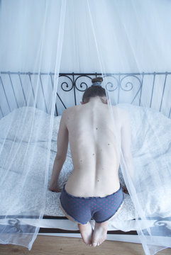 Espalda de una chica con escoliosis leve