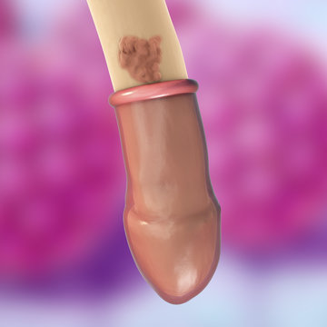 Common locations of genital warts, Human papillomavirus HPV lesions in men. 3D illustration showing ineffectiveness of comdom in protection against HPV transmission