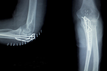 Elbow joint implant xray
