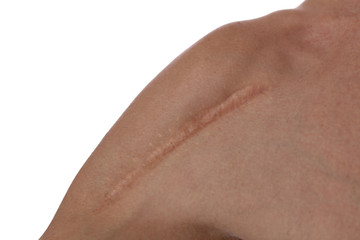 Fototapeta premium Man with scar on his shoulder close up. Laser Scar Reduction concept