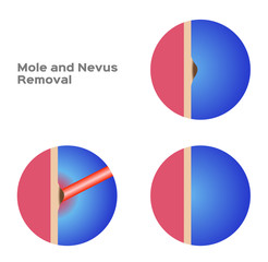 mole and nevus removal vector