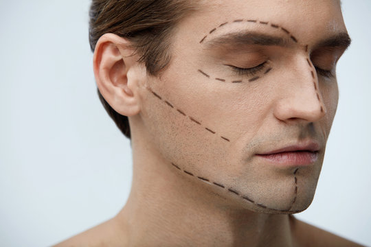 Plastic Surgery. Portrait Of Handsome Man With Lines On Face