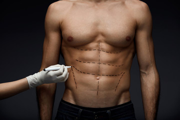 Male Body With Lines Before Beauty Operation. Plastic Surgery