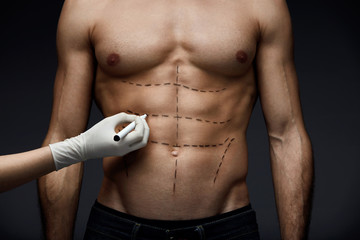 Male Body With Lines Before Beauty Operation. Plastic Surgery