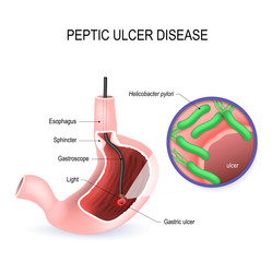 Peptic ulcer disease (PUD), stomach ulcer or gastric ulcer - obrazy, fototapety, plakaty