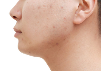 Obraz premium Young man with problem skin on white background, closeup