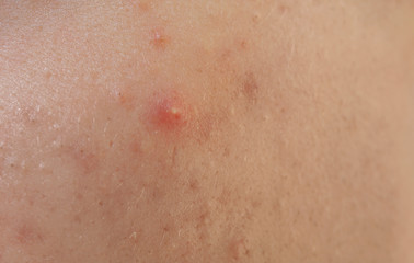 Human skin with acne, closeup