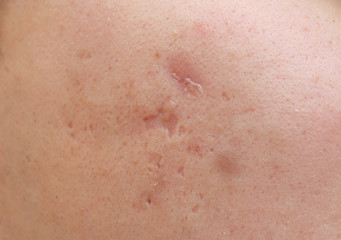Young man with problem skin, closeup