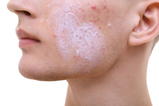Handsome young man with cream for problem skin applied onto face, closeup