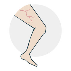 Leg with varicose veins