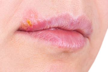 Fototapeta premium Herpes on the lip close up macro