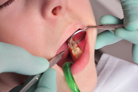 Close Up Of Hole, Cavity In Tooth After Drilling, With Filling Dental Tool And Mirror